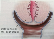 Cervical cancer screening is not that simple, these techniques can help you improve sampling quality